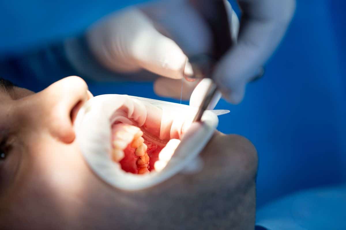 Pain Free Root Canal – An Overview